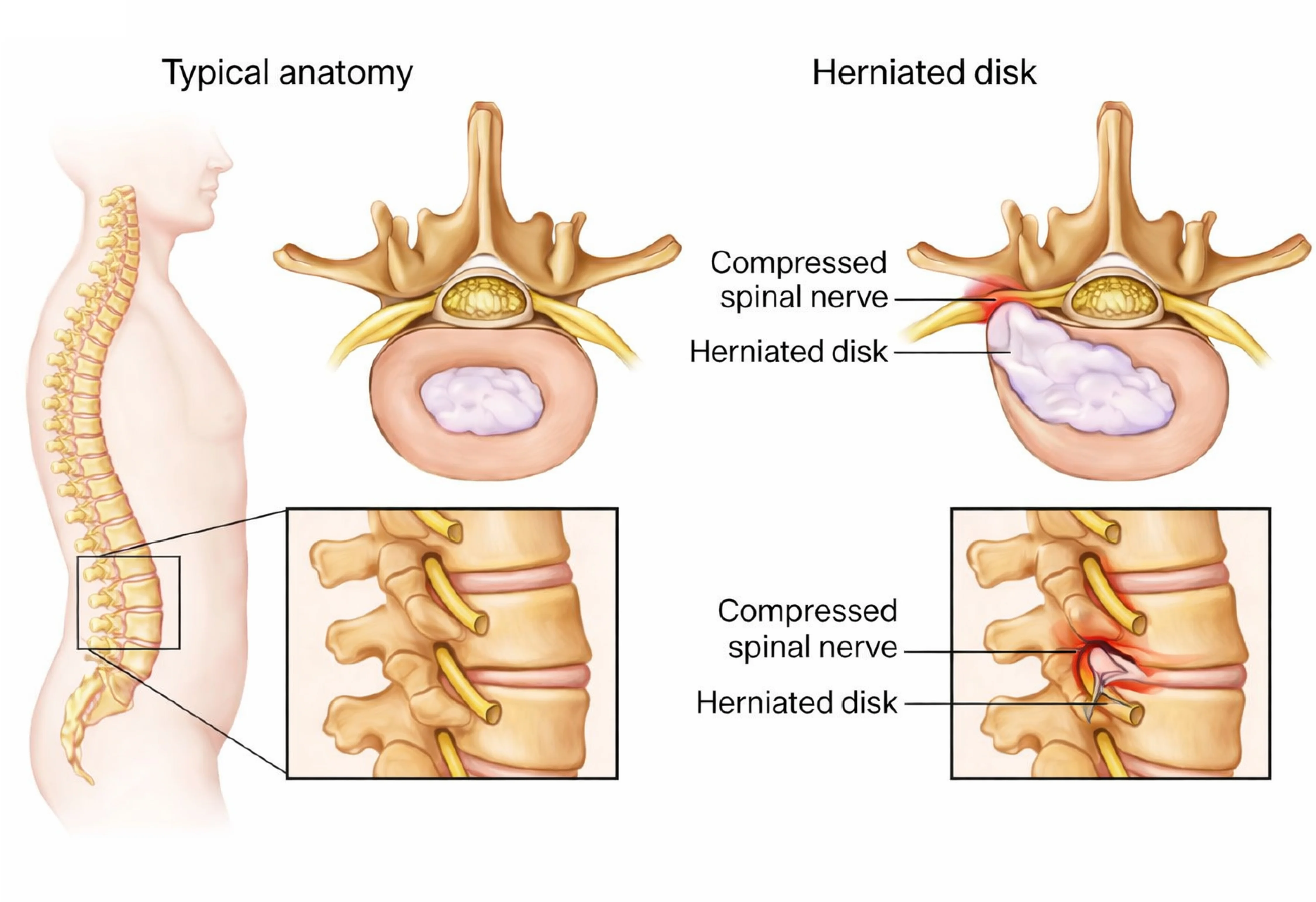 Slip Disc Treatment & Spine Care